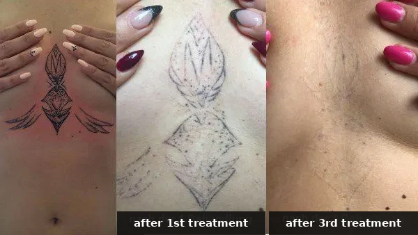 Progress of a tattoo removal on the sternum: before, after the 1st and after the 3rd treatment