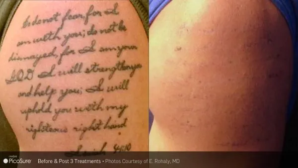 Schriftzug-Tattoo nach drei Sitzungen stark aufgehellt – Grundlage für ein Cover-up