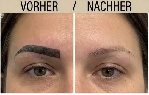 Vorher-Nachher: Permanent Make-up der Augenbrauen entfernt