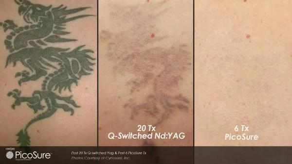 Vergleich: Tattoo nach 20 Behandlungen mit Nanosekundenlaser und nach 6 Behandlungen mit dem PicoSure