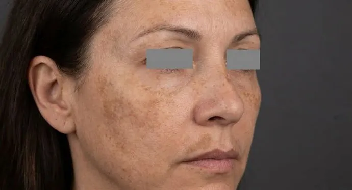 Pigmentflecken und Melasma im Gesicht vor der Behandlung