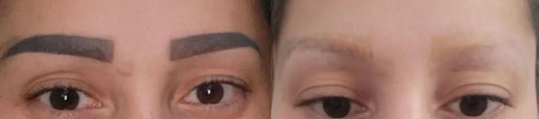 Before/after: eyebrow microblading removed after 4 treatments