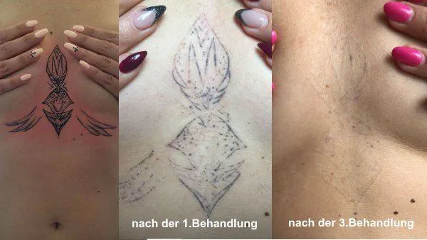 Verlauf einer Tattooentfernung am Brustbein: vorher, nach der 1. und nach der 3. Behandlung