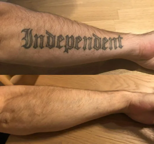 Before/after: black lettering on the forearm, completely removed after 6 sessions with the PicoSure laser